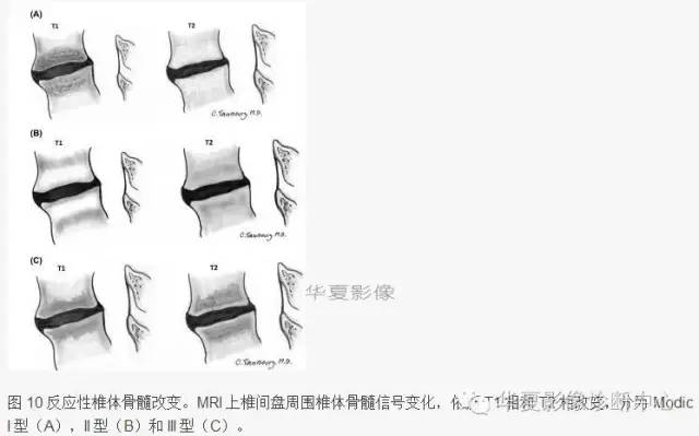 椎间盘膨出、突出、变性图解