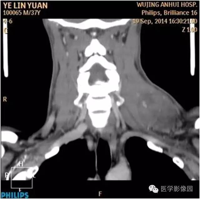 【病例】左颈部神经鞘瘤1例CT影像表现
