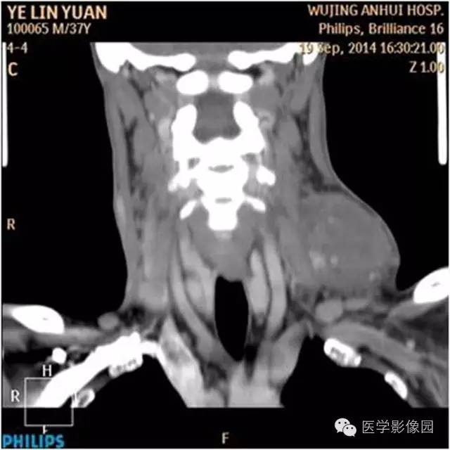 【病例】左颈部神经鞘瘤1例CT影像表现