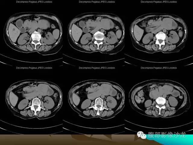 【病例】十二指肠腺瘤1例CT影像表现