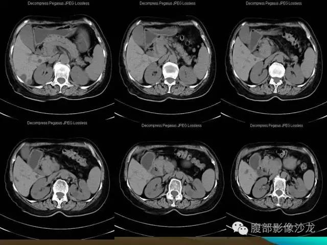 【病例】十二指肠腺瘤1例CT影像表现