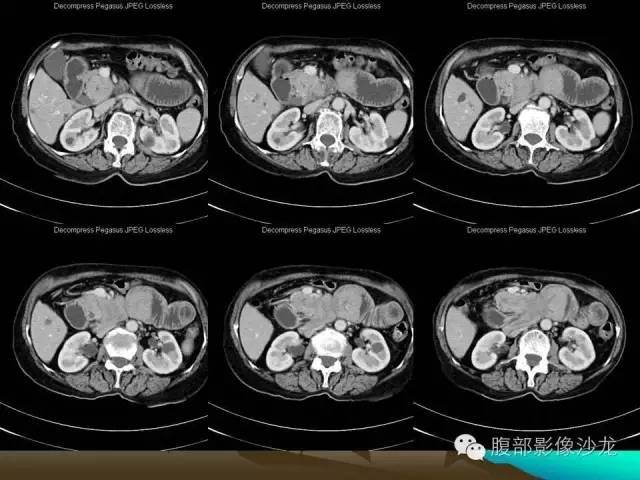 【病例】十二指肠腺瘤1例CT影像表现