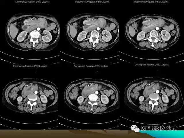 【病例】十二指肠腺瘤1例CT影像表现