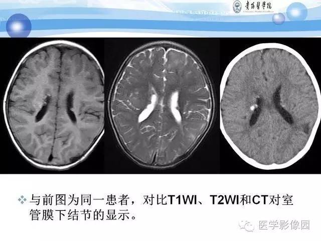 【PPT】 结节性硬化症颅脑病变MRI征象分析