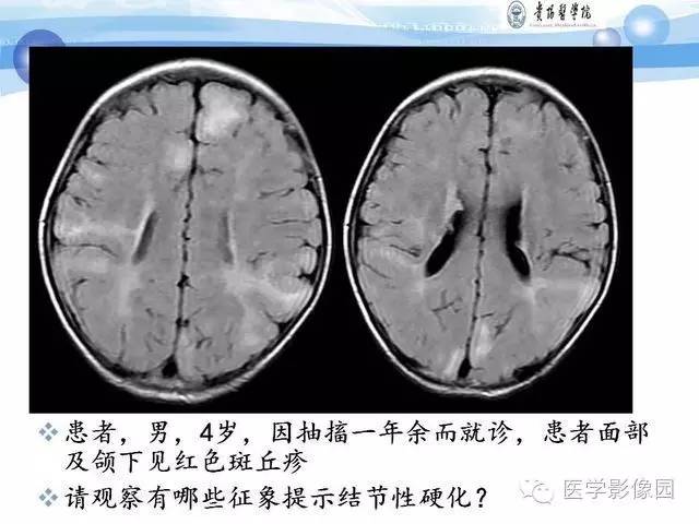 【PPT】 结节性硬化症颅脑病变MRI征象分析