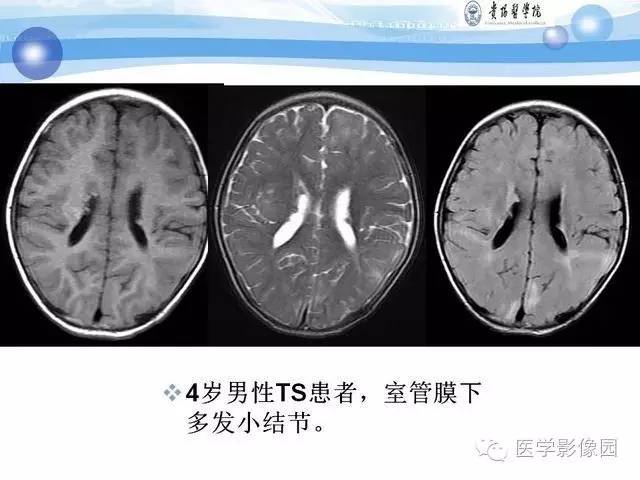 【PPT】 结节性硬化症颅脑病变MRI征象分析