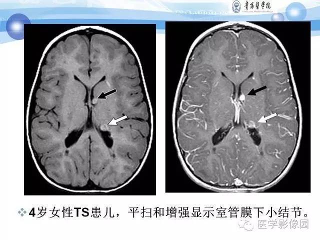 【PPT】 结节性硬化症颅脑病变MRI征象分析