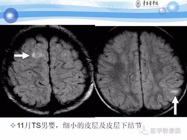 【PPT】 结节性硬化症颅脑病变MRI征象分析