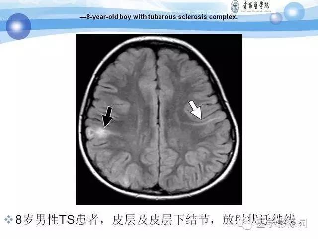 【PPT】 结节性硬化症颅脑病变MRI征象分析