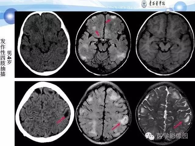 【PPT】 结节性硬化症颅脑病变MRI征象分析