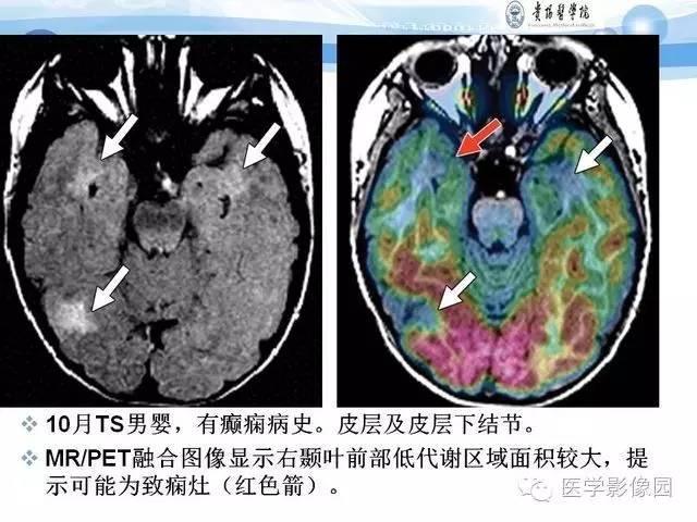 【PPT】 结节性硬化症颅脑病变MRI征象分析