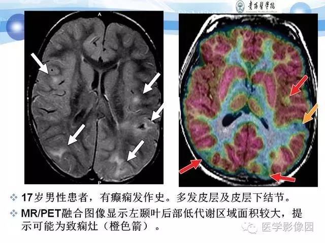 【PPT】 结节性硬化症颅脑病变MRI征象分析