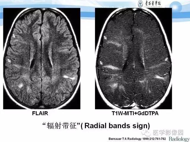 【PPT】 结节性硬化症颅脑病变MRI征象分析