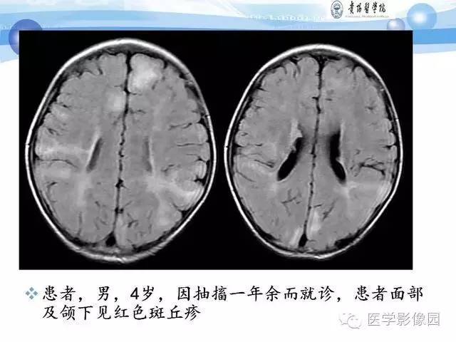 【PPT】 结节性硬化症颅脑病变MRI征象分析