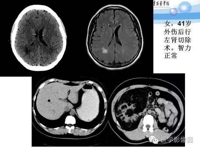 【PPT】 结节性硬化症颅脑病变MRI征象分析