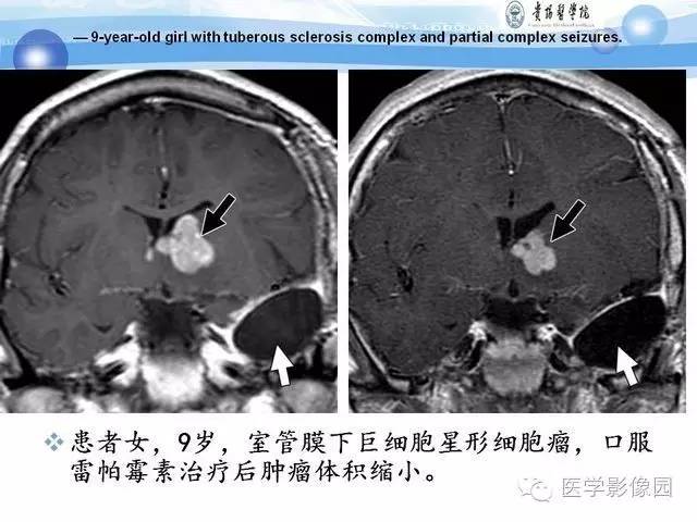 【PPT】 结节性硬化症颅脑病变MRI征象分析