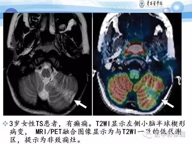 【PPT】 结节性硬化症颅脑病变MRI征象分析