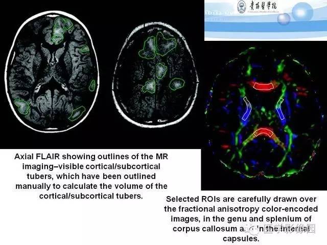 【PPT】 结节性硬化症颅脑病变MRI征象分析