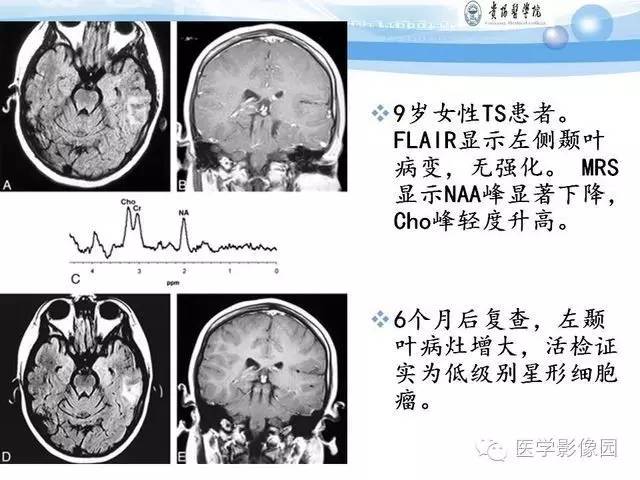 【PPT】 结节性硬化症颅脑病变MRI征象分析