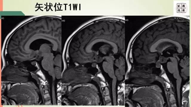 【病例】下丘脑生殖细胞瘤1例MR影像表现
