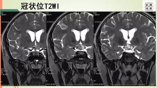 【病例】下丘脑生殖细胞瘤1例MR影像表现