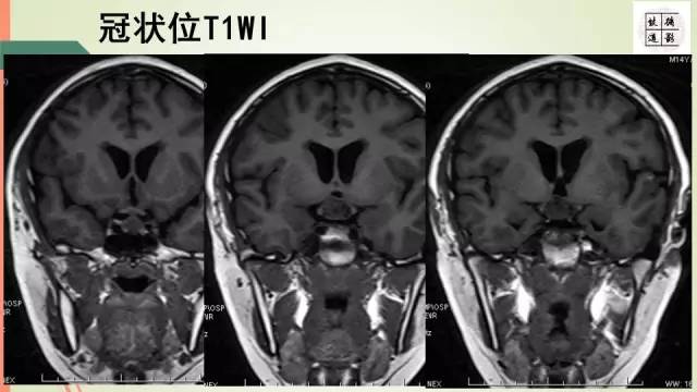 【病例】下丘脑生殖细胞瘤1例MR影像表现