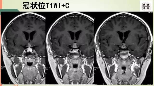 【病例】下丘脑生殖细胞瘤1例MR影像表现