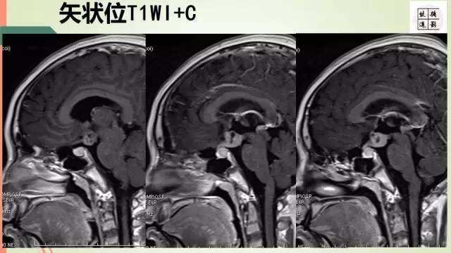 【病例】下丘脑生殖细胞瘤1例MR影像表现