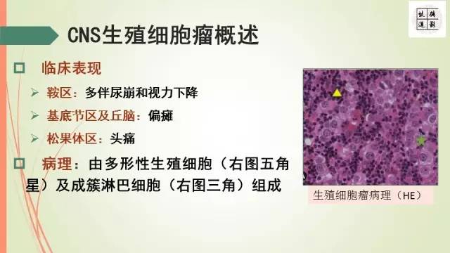【病例】下丘脑生殖细胞瘤1例MR影像表现