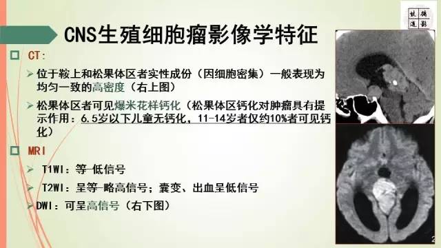 【病例】下丘脑生殖细胞瘤1例MR影像表现