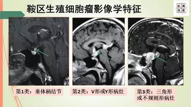 【病例】下丘脑生殖细胞瘤1例MR影像表现