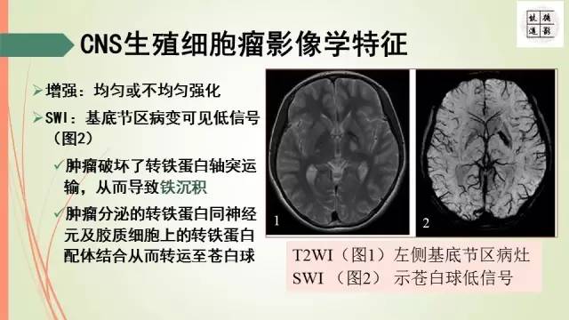 【病例】下丘脑生殖细胞瘤1例MR影像表现