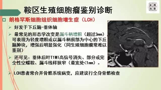 【病例】下丘脑生殖细胞瘤1例MR影像表现