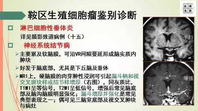 【病例】下丘脑生殖细胞瘤1例MR影像表现