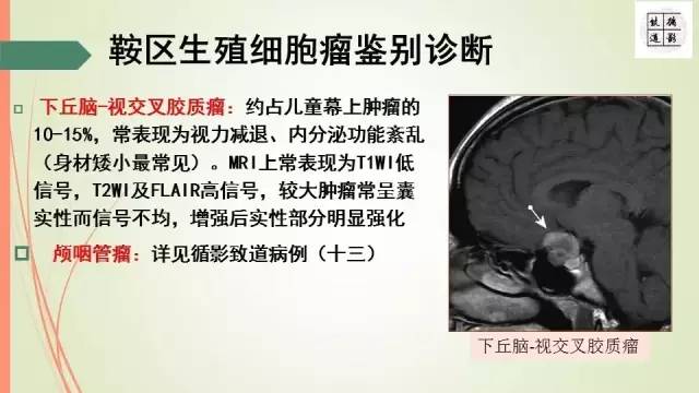 【病例】下丘脑生殖细胞瘤1例MR影像表现