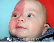 【病例】脑颜面部血管瘤综合征1例CT及MR影像表现 【病例】脑颜面部血管瘤综合征1例CT及MR影像表现