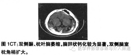 【病例】脑颜面部血管瘤综合征1例CT及MR影像表现 【病例】脑颜面部血管瘤综合征1例CT及MR影像表现