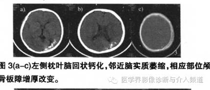 【病例】脑颜面部血管瘤综合征1例CT及MR影像表现 【病例】脑颜面部血管瘤综合征1例CT及MR影像表现