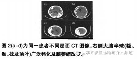 【病例】脑颜面部血管瘤综合征1例CT及MR影像表现 【病例】脑颜面部血管瘤综合征1例CT及MR影像表现