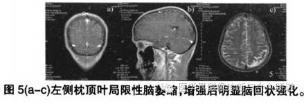 【病例】脑颜面部血管瘤综合征1例CT及MR影像表现 【病例】脑颜面部血管瘤综合征1例CT及MR影像表现