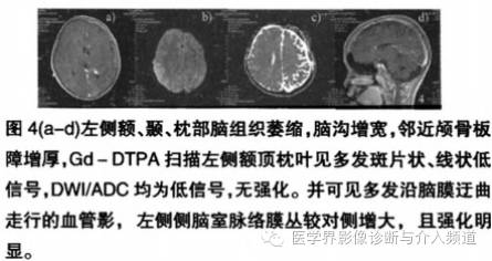 【病例】脑颜面部血管瘤综合征1例CT及MR影像表现 【病例】脑颜面部血管瘤综合征1例CT及MR影像表现