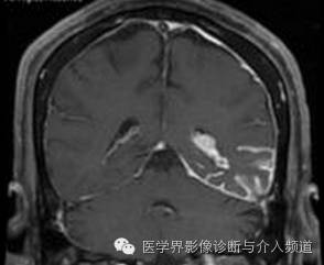 【病例】脑颜面部血管瘤综合征1例CT及MR影像表现 【病例】脑颜面部血管瘤综合征1例CT及MR影像表现
