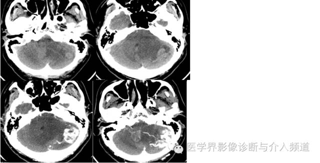 【病例】血管母细胞瘤2例CT及MR影像表现