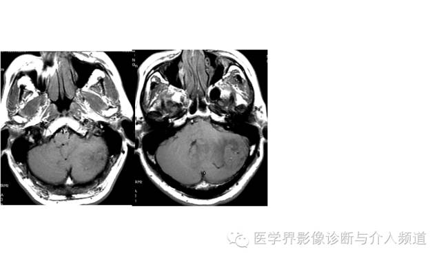 【病例】血管母细胞瘤2例CT及MR影像表现