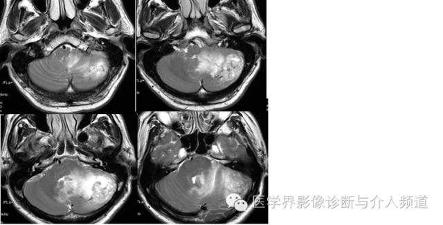 【病例】血管母细胞瘤2例CT及MR影像表现
