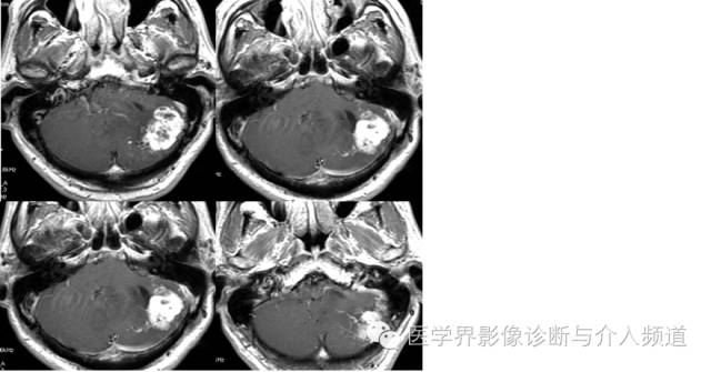【病例】血管母细胞瘤2例CT及MR影像表现