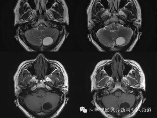 【病例】血管母细胞瘤2例CT及MR影像表现