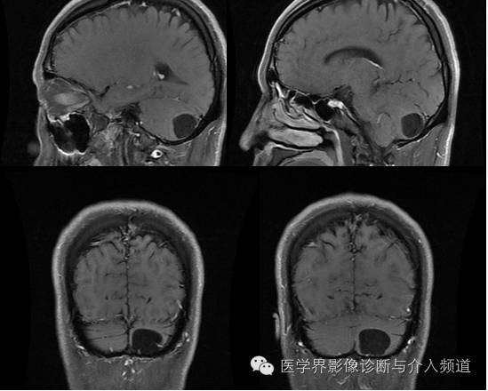 【病例】血管母细胞瘤2例CT及MR影像表现