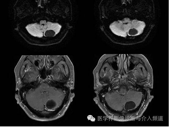 【病例】血管母细胞瘤2例CT及MR影像表现