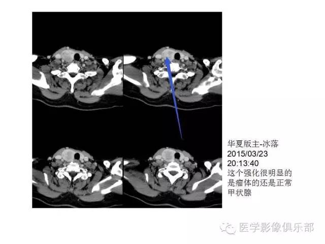 甲状腺腺瘤与甲状腺癌的鉴别